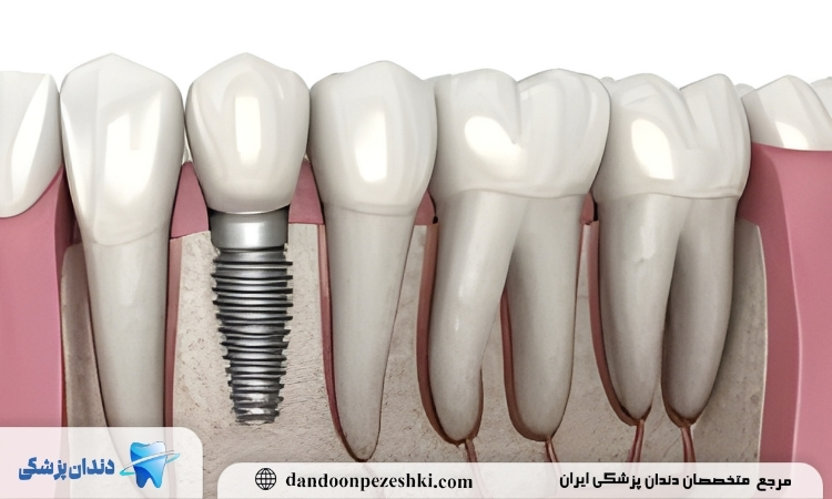 کاشت ایمپلنت دو مرحله ای