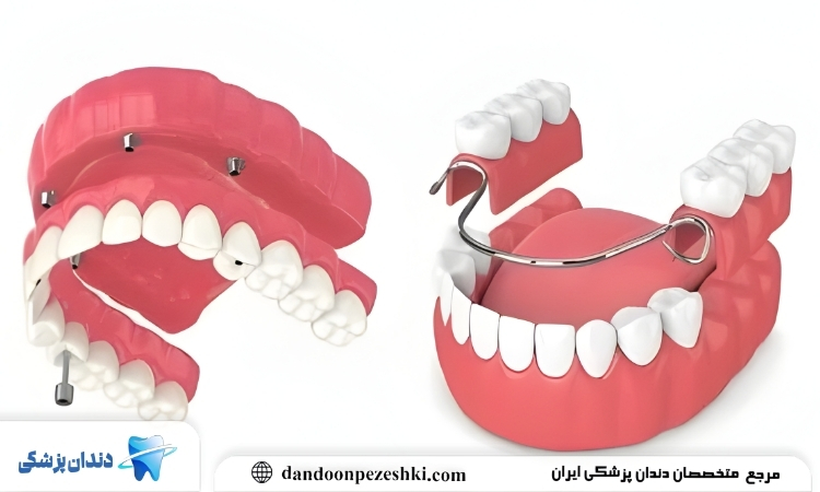 ایمپلنت چیست؟