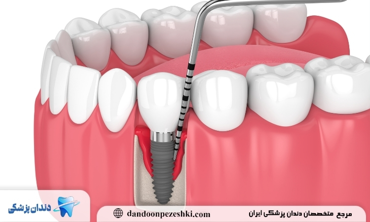 کاشت ایمپلنت دندان