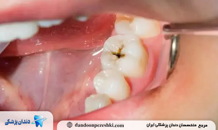 کامپوزیت دندان پوسیده