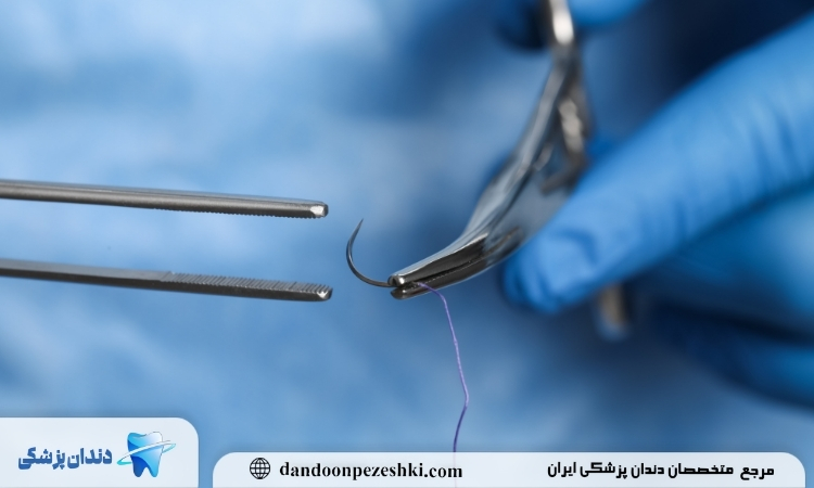بخیه در دندانپزشکی