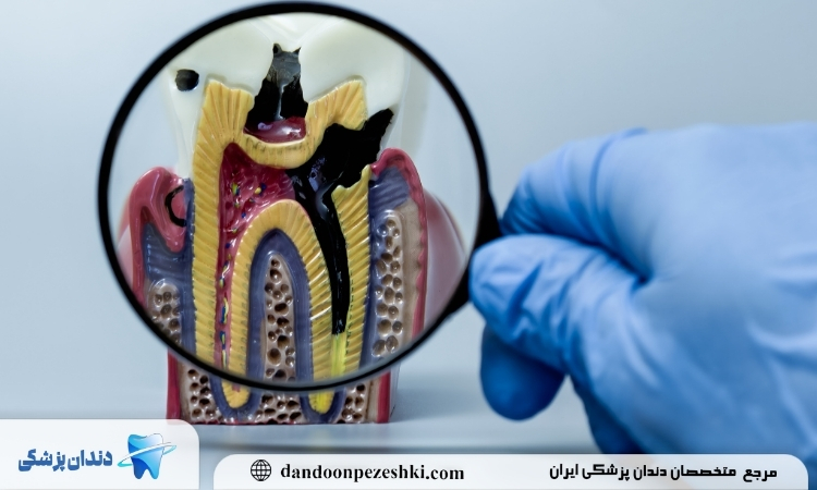 کپسول برای عفونت دندان