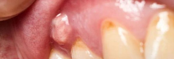 آبسه دندان در کودکان چند روز طول میکشد؟