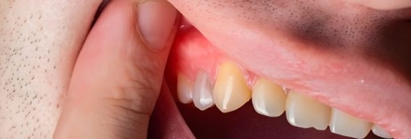 انواع ورم لثه