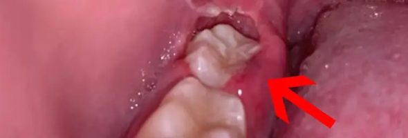 بهبودی عفونت دندان عقل چقدر طول می کشد؟