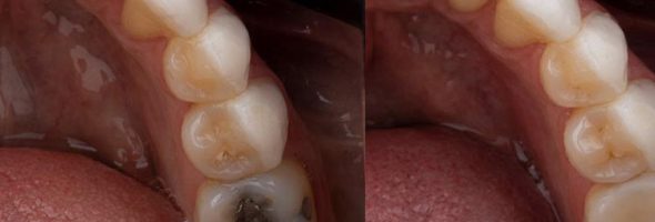 تفاوت پر کردن با روکش دندان