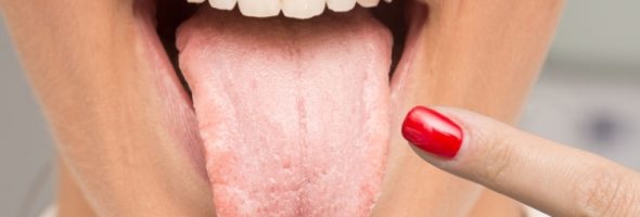 دلایل، علائم و راه های درمان برفک دهانی