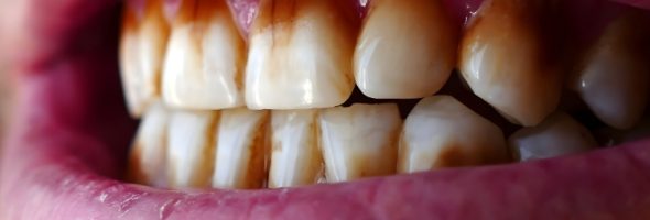 علت ایجاد لکه قهوه ای و زرد روی دندان ها چیست؟