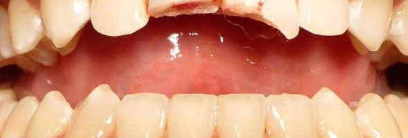 علت خرد شدن دندان جلو