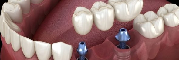 عمر ایمپلنت کره ای چقدر است؟