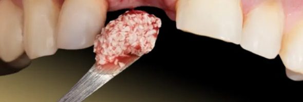 عوارض پیوند استخوان از لگن