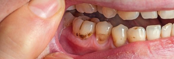 قلیان کشیدن بعد از کامپوزیت دندان