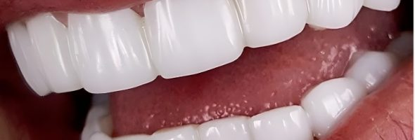 مزایا و معایب لمینت دندان