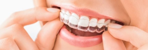 معایب ارتودنسی نامرئی