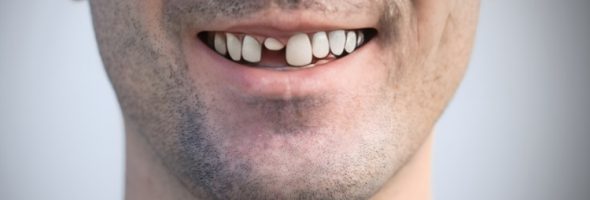 هزینه ترمیم دندان جلو