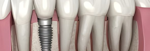 کاشت ایمپلنت دو مرحله ای